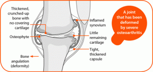 12404-ar-osteoarthritis3