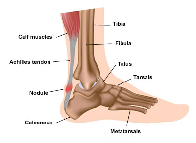Achilles Tendonitis - advice and 
