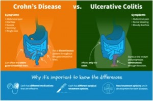 Crohn S Disease Vs Ulcerative Colitis Chart