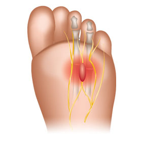 mortons_neuroma